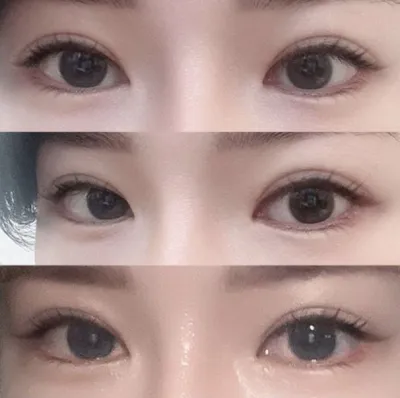 Nếu phải phẫu thuật lại thì mọi người đến Weverse nhé!! Hehe