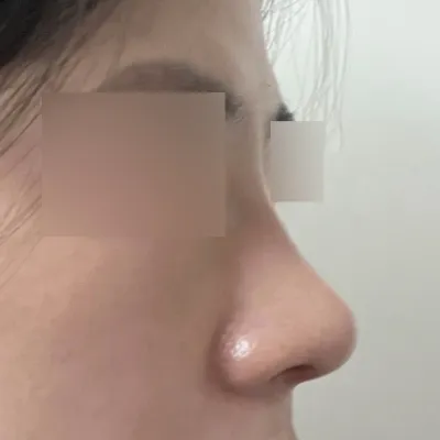 Mình đã phẫu thuật thu nhỏ đầu mũi