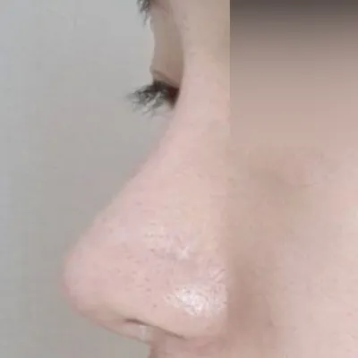 Mình đã phẫu thuật viêm mũi và phẫu thuật mũi cùng nhau!