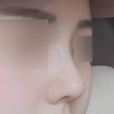 Đã 1 tháng kể từ khi phẫu thuật mũi