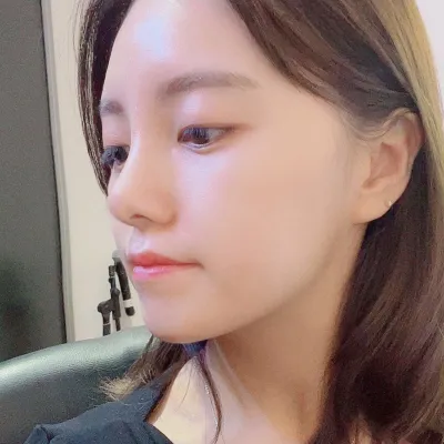 Đã được 1 tháng kể từ khi mình phẫu thuật thẩm mỹ mũi tại Weavers