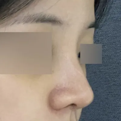 Mình đã phẫu thuật được 2 tuần rồi ạ