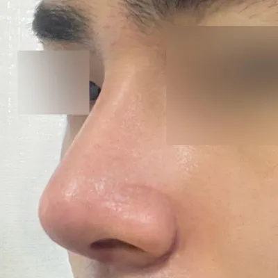 Đã 2 tuần kể từ khi mình phẫu thuật tại bệnh viện phẫu thuật thẩm mỹ Weavers.