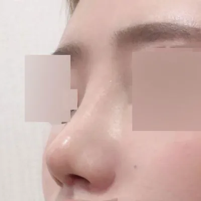 Mình đã phẫu thuật lại mũi tròn!