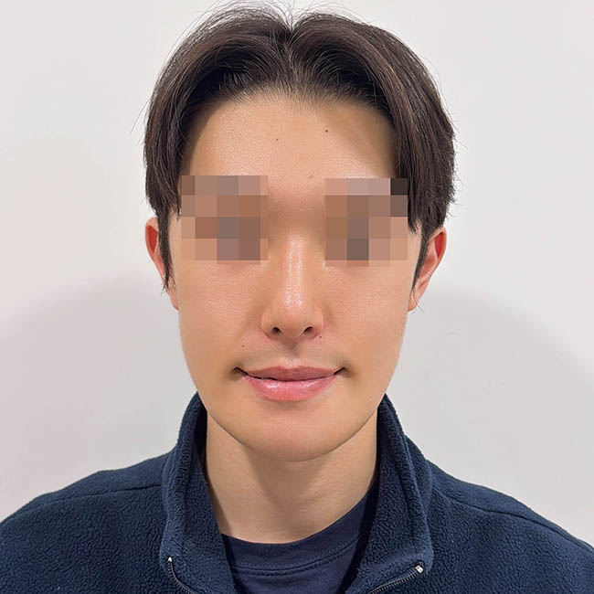 안면윤곽 코수술 함께 받았습니다!