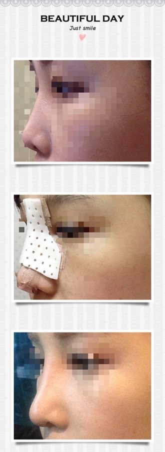 Ngày thứ 10 sau phẫu thuật mũi!!!