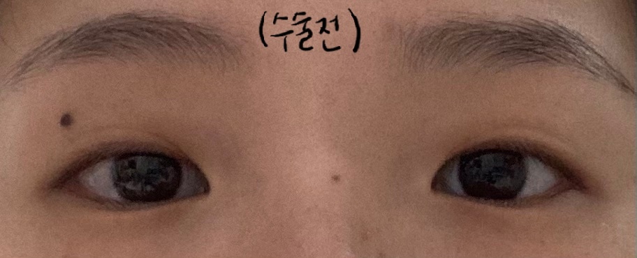 Review sau khi cắt mí + mở góc mắt