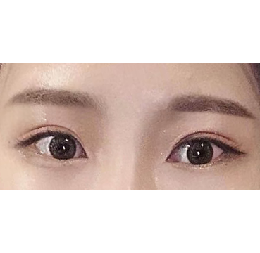 Mình cắt mí mắt và chỉnh sửa cơ nâng mí được một tháng rồi ạ.