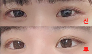 Cắt mí thành công rồi nè