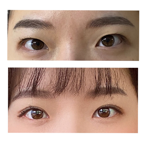 Review 2 tháng sau khi cắt mí chôn + mở góc mắt trước!