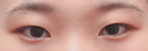 Cắt mí và mở góc mắt trước được 1 tháng rồi nè