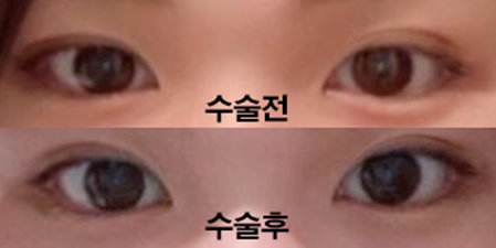 Tái phẫu thuật mắt hai mí được 3 tháng rồi ạ!