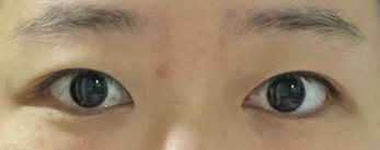 Review 5 tháng sau cắt mí và mở góc mắt trong