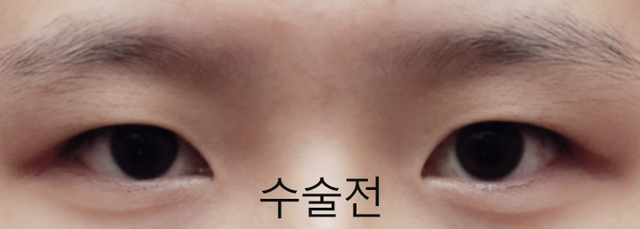 Review thật lòng về cắt mí mắt + mở góc mắt trước, sau và dưới!!