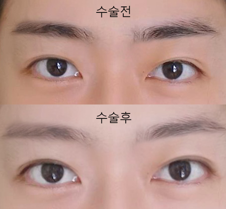 Làm mí mắt chôn