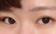 Mình đã làm mắt 2 mí (không rạch) + mở góc mắt trước được 1 tháng rồi nè!!!!