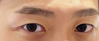 Sửa Mắt 1 Mí Được 1 Tháng òi