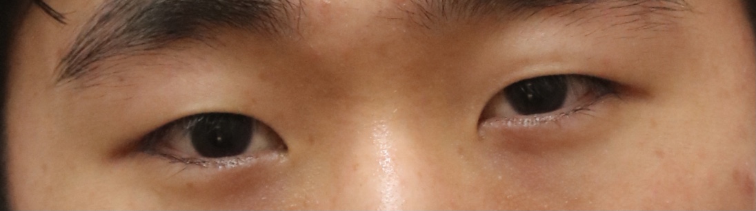 Được một tuần rồi! Hôm nay mình cắt chỉ đó~!