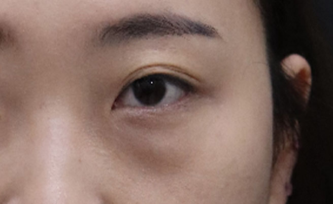 재수술이라 더 신중하게 발품을 여기저기 팔았으나, 최현정실장님과 김용우원장님이 설명을 꼼꼼히 잘해주시고 편안하게 해주셔서 결정하게 되었습니다.