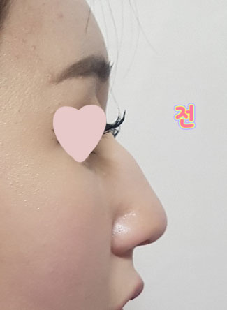 주변에서도 코 이쁘게 됐다고 다들 칭찬해줬어욤