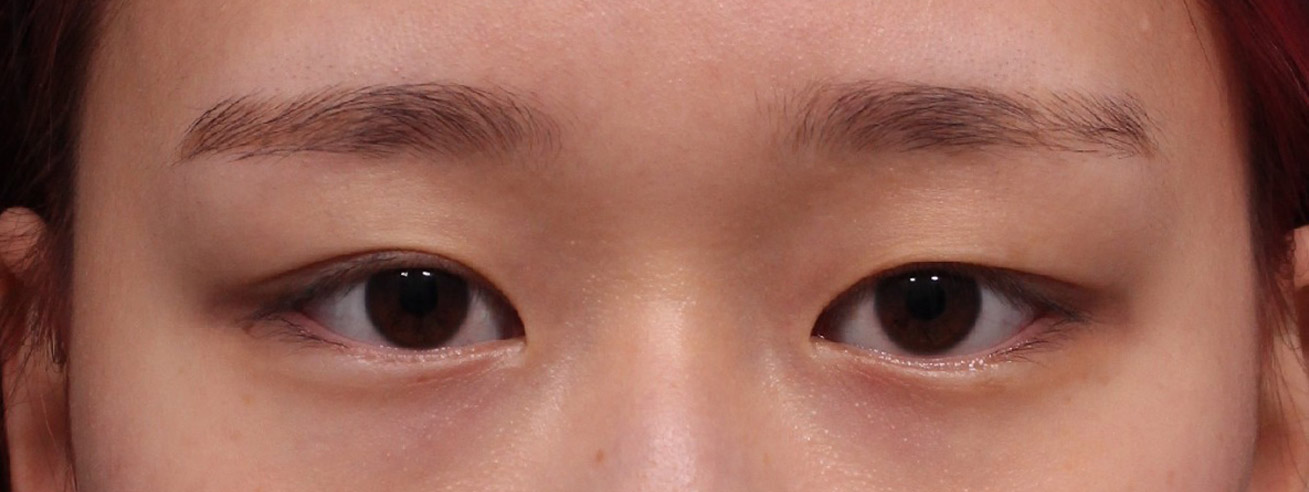 병원 내부도 깔끔하고 다 친절하셔서 부담없이 상담부터 수술 , 추후 관리까지 한거 같아요