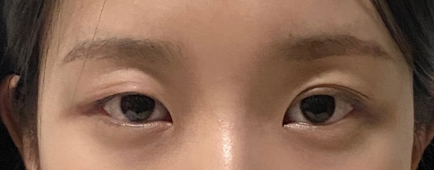 쌍테 안붙이고 다니니 삶의 질이 좀 달라졌습니당.. 넘 만족해요>_