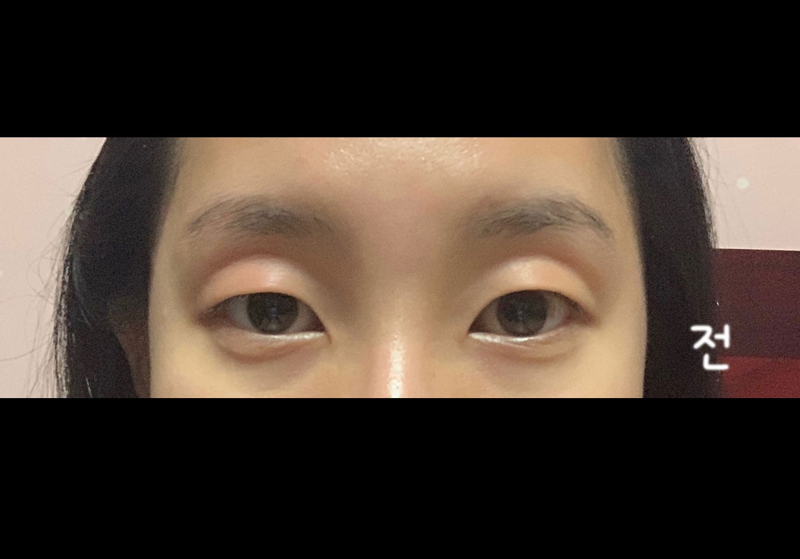 다들 앞트임 꼭 하세요 ㅜㅜ