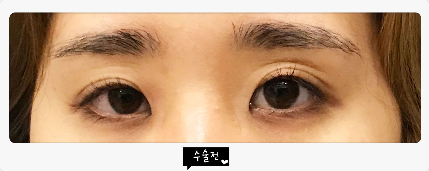 베리굿 성형외과 후기입니다