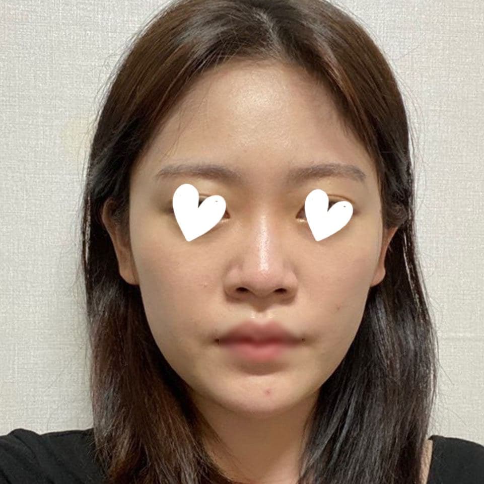 코 수술 하나로 이미지 변신해서 기분좋네요 ❤️