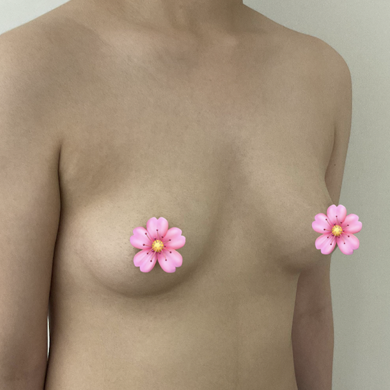 가장 만족하는 가슴수술