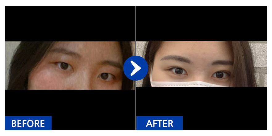 [바비톡] 쌍꺼풀 /2개월차 / 닉네임 : 유림08