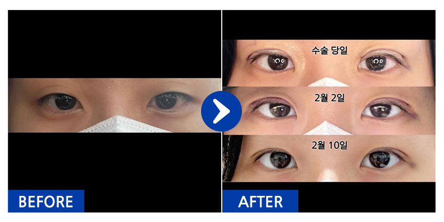 [강남언니] 자연유착 / 1개월차 / 닉네임 : 활쏴비아