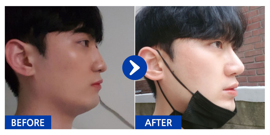 [강남언니] 코성형 / 6개월차 / 닉네임 : 핵규