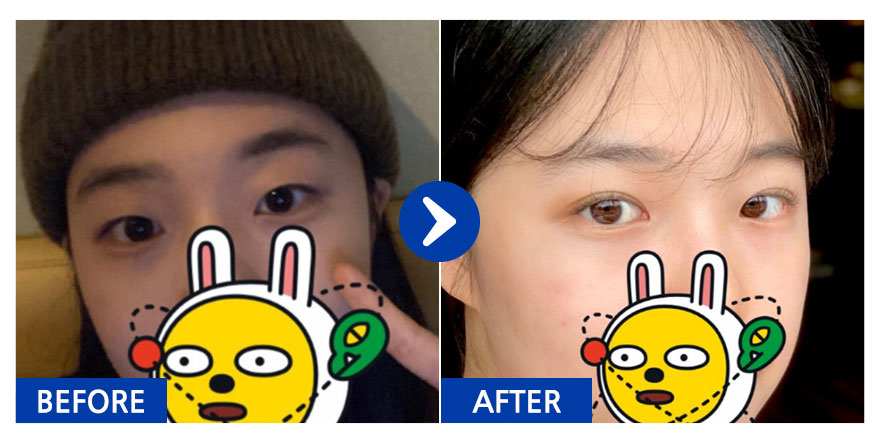 [강남언니] 자연유착 / 1개월차 / 닉네임:챈집사