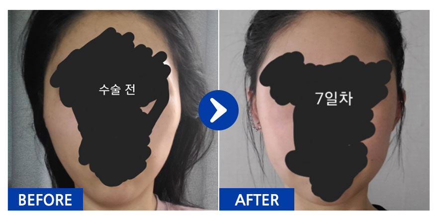 [강남언니] 광대 / 1개월차 / 닉네임:고기를위한고기