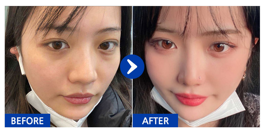 [강남언니] 눈밑지방재배치 / 6개월차/ 닉네임:장래희망강남미인