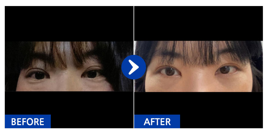 [강남언니] 눈밑지방재배치 / 1개월차/ 닉네임: 김ㅇ현