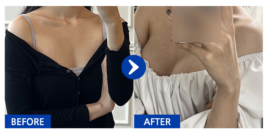 [바비톡] 멘토가슴성형 1개월차 / 닉네임 : 한솔솔바람