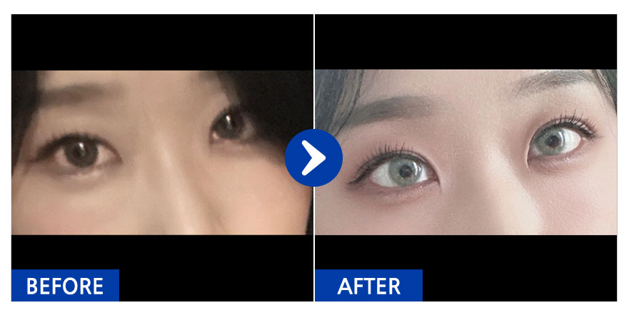 [강남언니] 눈밑지방재배치 / 1개월차 / 닉네임 : hyupp