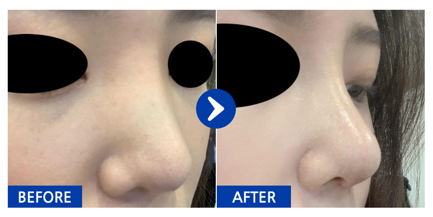 [바비톡] 코성형 1개월차/ 닉네임:융이나