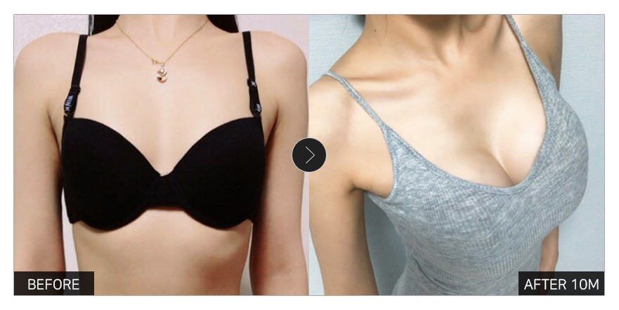 [강남언니 후기] 가슴성형 10개월차 / 닉네임 : 그마아아안