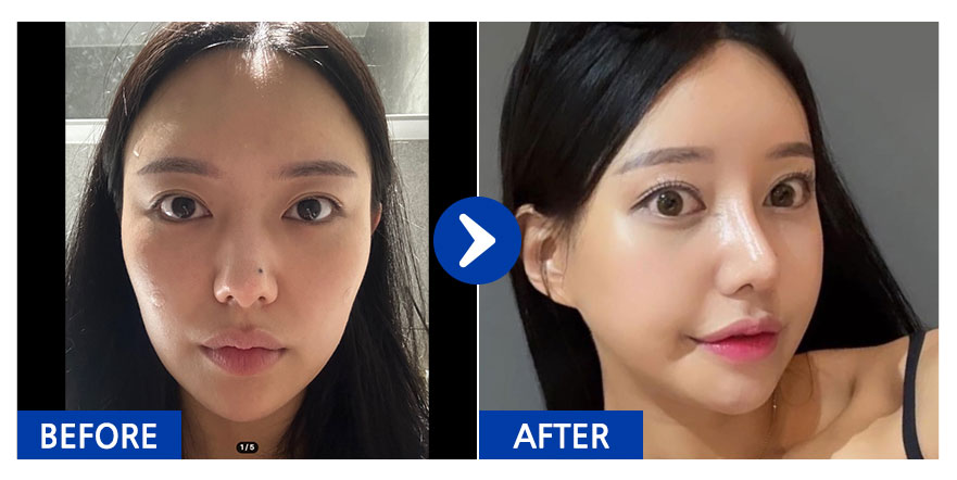 [강남언니 후기] 윤곽3종(광대,턱끝,사각턱), 코성형 / 3주차 / 닉네임:박땐땐