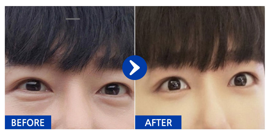 [강남언니] 눈밑지방재배치 1개월차 / 닉네임 : 크리스으