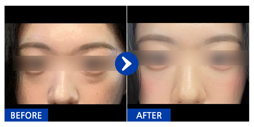 [강남언니] 눈밑지방재배치 / 1개월차 / 닉네임 : 밍밍한뀰