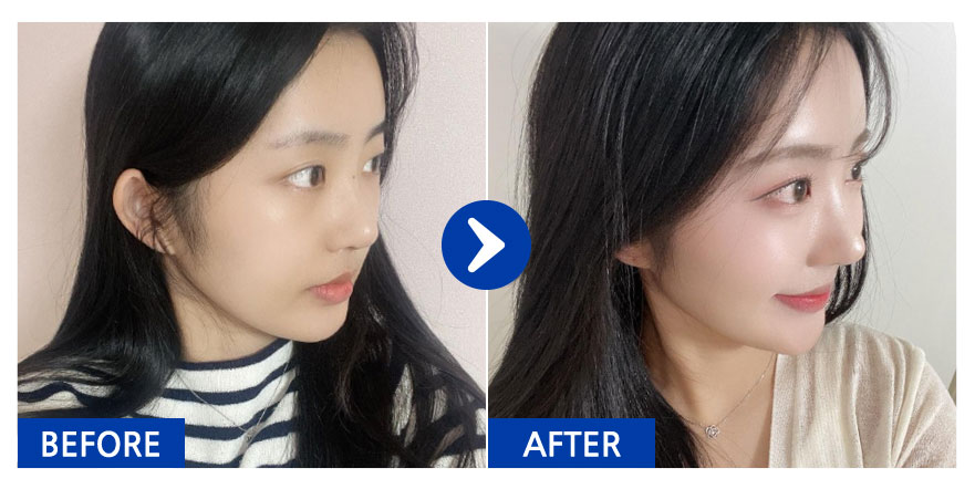 [바비톡] 코성형, 이마지방이식 / 2주차 / 닉네임 : 냥냥냥웅웅