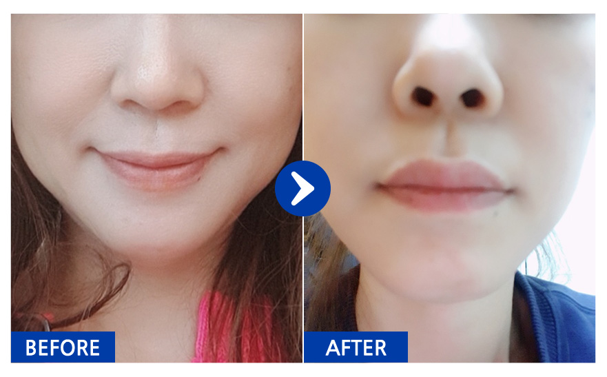 [강남언니 후기] 미니거상 / 1개월차 / 닉네임:홍대마녀