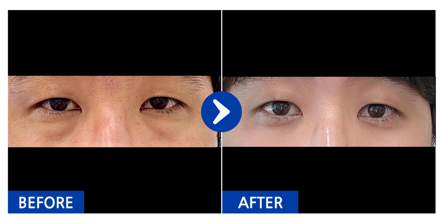 [강남언니] 눈밑지방재배치 / 1개월차 / 닉네임 : 펭베리