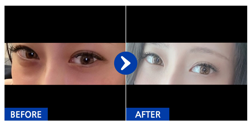 [강남언니] 눈밑지방재배치 / 1개월차 / 닉네임 : 몽둥이누나