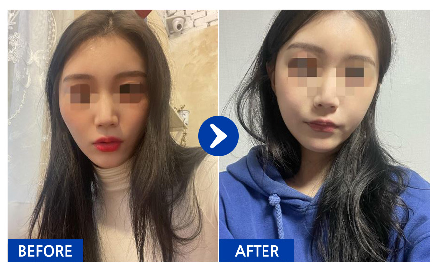 [바비톡] 안면윤곽 / 1개월차 / 닉네임 : 보르으음달