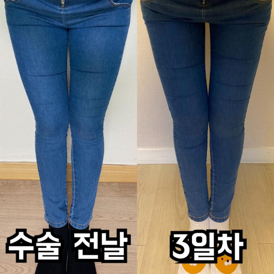 [강남언니 후기] 허벅지지방흡입 3일차 / 닉네임 : 뽀링꼬